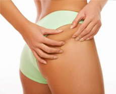 Liposuccion